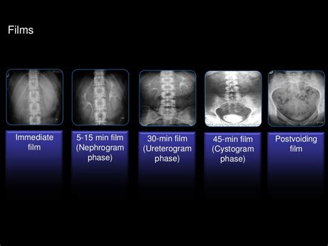 Intravenous urography (IVU)