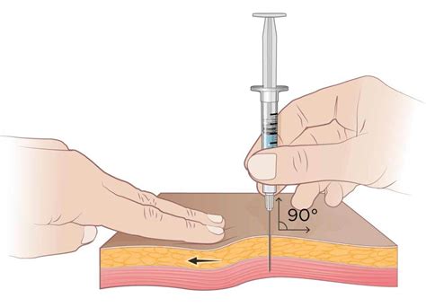 Z-Track Injection | Definition and Patient Education | Nursing school ...