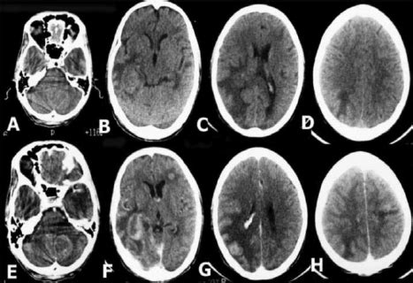 CT scan brain (plain and contrast images) showing multiple lesions... | Download Scientific Diagram