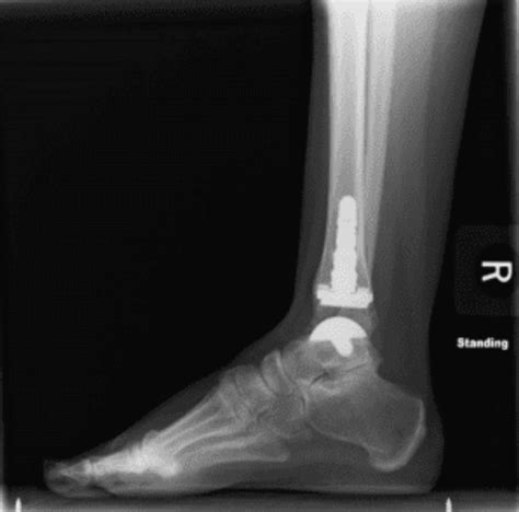 Total Ankle Replacement: Midwest Center for Joint Replacement: Hip and ...