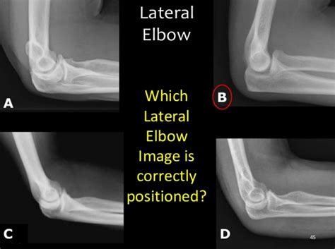 Good lateral elbow | Diagnostic imaging, Radiology schools, Xray tech