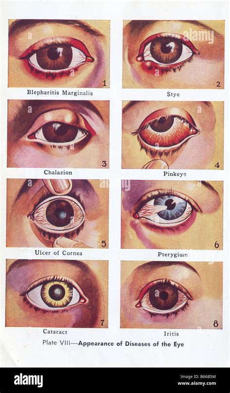 medical book eye diseases illustration Stock Photo: 21038800 - Alamy