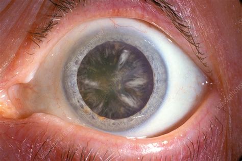 Cortical cataract - Stock Image - C034/5709 - Science Photo Library