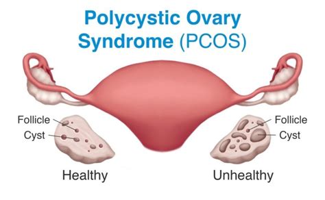 What is Poly cystic Ovary Syndrome (PCOS) and its Causes? | My Gynae