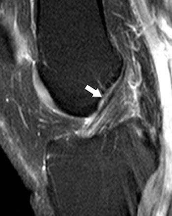 mri acl normal