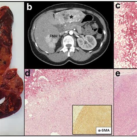 Case 2: (a) PEComa: epithelioid cells and spindle cells in a solid and... | Download Scientific ...