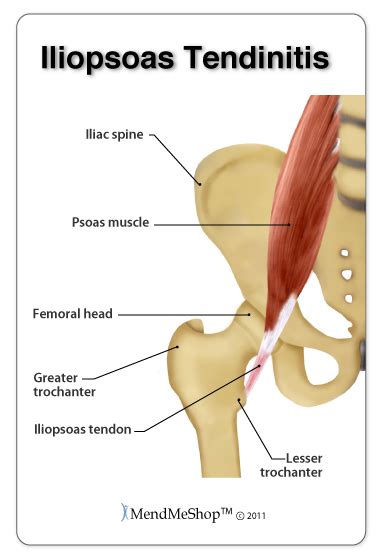 Hip Flexor Strain-Tear