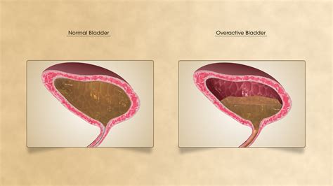 Suffering from Overactive Bladder? - Scientific Animations