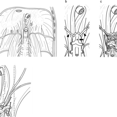 The anatomy around the median arcuate ligament. a The anatomy of the ...