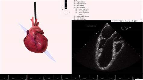 What Is Global Left Ventricular Hypokinesis - QLABOL