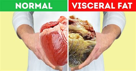 What is Visceral Fat?