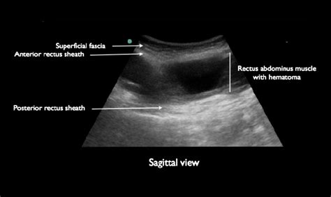 Ultrasound Diagnosis of Rectus Sheath Hematoma - Journal of Emergency ...