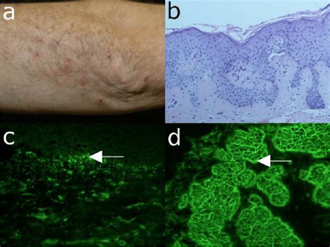 Epidermolysis Bullosa Acquisita