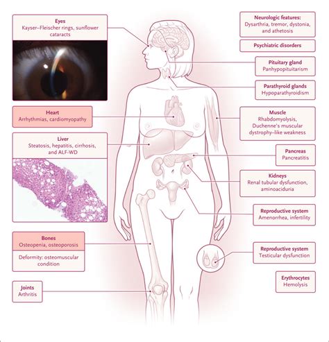 Current and Emerging Issues in Wilson’s Disease | NEJM