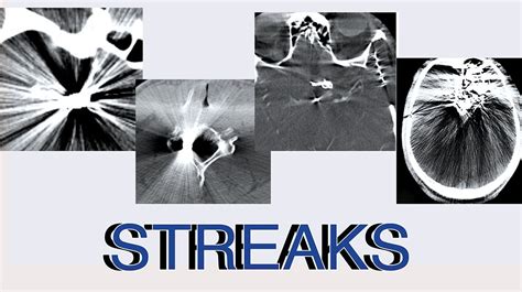 CT Scanner Artifacts- How Do I Correct Streaks?