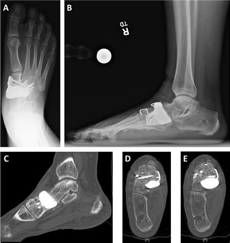 Figure 5 from Talonavicular Joint-Sparing 3D Printed Navicular Replacement for Osteonecrosis of ...
