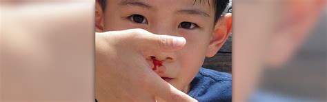 Frequent nose bleeds | Ear, Nose, Throat, and Dental problems articles | Body & Health ...