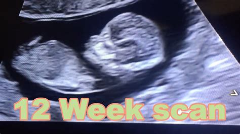 Cute & clear ultrasound of baby Micah | 12 Week scan! - YouTube