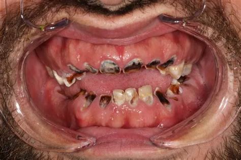 Pictured: Man's incredible transformation after having rotten teeth removed - Dublin Live