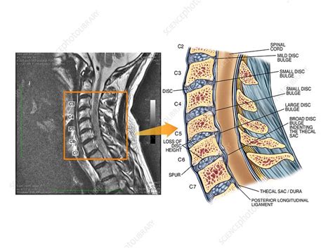 Cervical Spine Bulging Disc