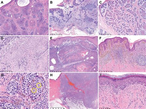 Clinicopathological Factors Influencing Resection Margin Involvement During Mohs Micrographic ...