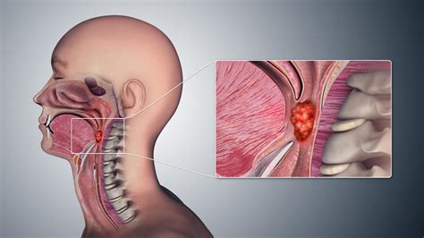 Less Treatment for HPV-Related Oropharyngeal Cancer - NCI