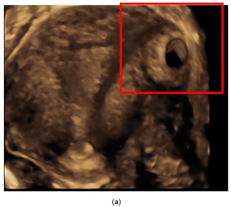 IJERPH | Free Full-Text | Interstitial Ectopic Pregnancy: The Role of ...