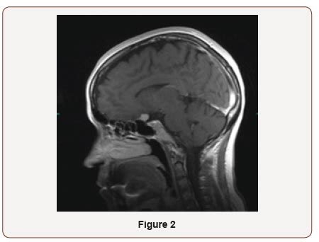 Visual Recovery After Decompression Surgery of Skull Base Meningioma: A Case Report | Iris ...