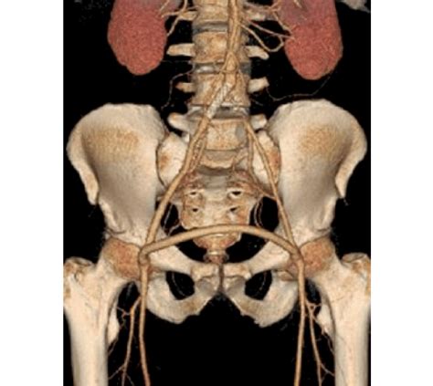 Femoral Artery Incision