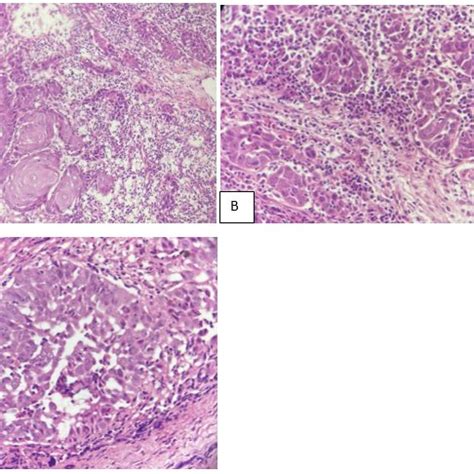 A: Keratin pearls noted along with some epithelial islands (Hematoxylin... | Download Scientific ...