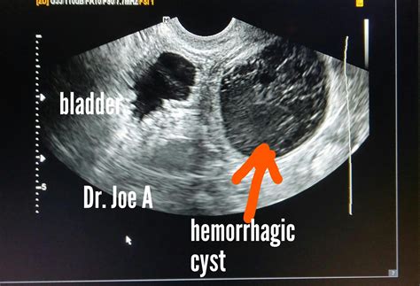 Hemorrhagic Cyst Ultrasound