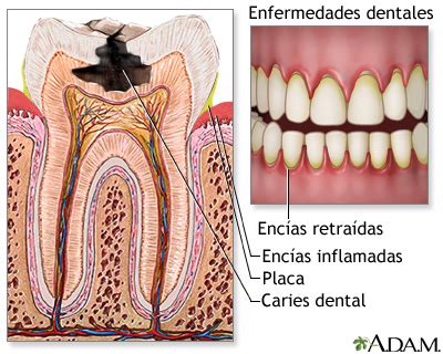 Caries dentales: MedlinePlus enciclopedia médica