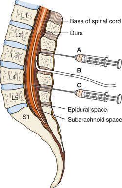 Definition of intrathecal anesthesia in the Medical Dictionary by The Free… Conversion Disorder ...