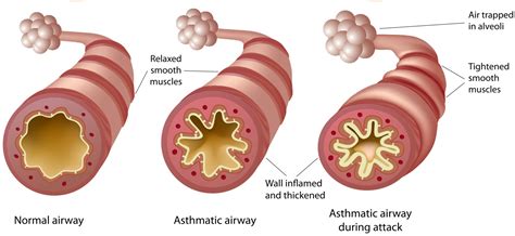 What Is Asthma? What Are Asthma Symptoms, Causes, Treatments And ...