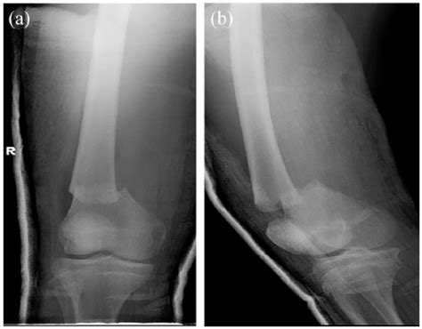 one leg shorter after femur fractures icd 10