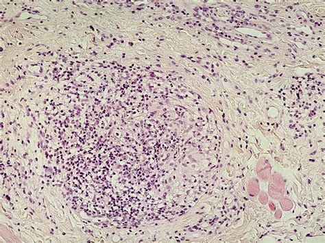 Melkersson-Rosenthal syndroom (cheilitis granulomatosa)