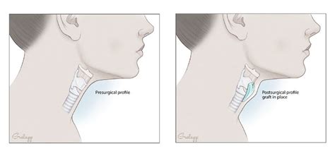 Adam’s Apple Surgery – Augmentation via Natural Implant for FTM Facial Gender Confirmation