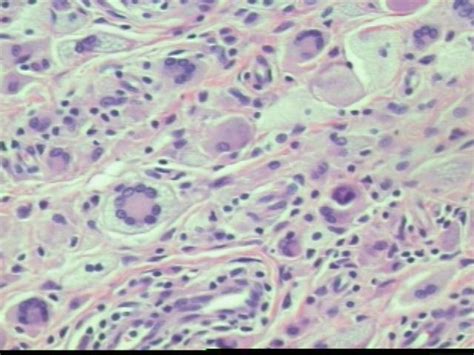 Pathology Outlines - Case of the Week #5