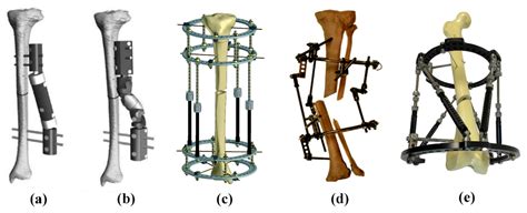 MS - Kinematic analysis and evaluation of a hybrid mechanism for computer assisted bone ...