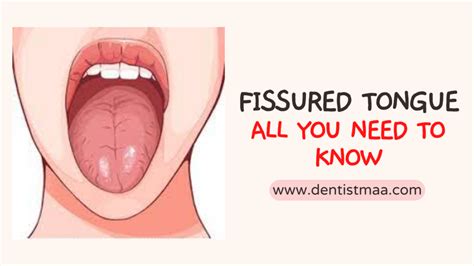 Fissured Tongue : All You Need To Know - DentistMaa