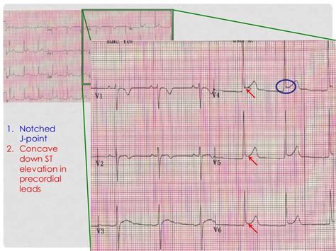 Benign Early Repolarization