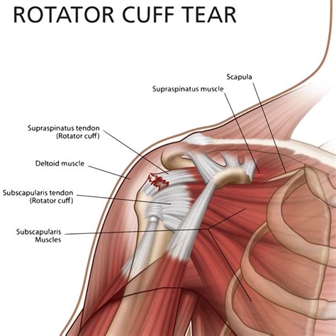 Shoulder Pain treatment Specialists - Delhi Pain Management Centre