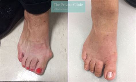 Bunion surgery before after photos UK 2024, Before and After pictures ...