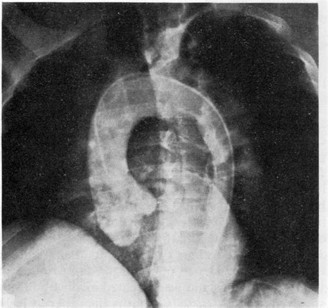 Case 2. Aortogram during first admission demonstrating abnormal ...