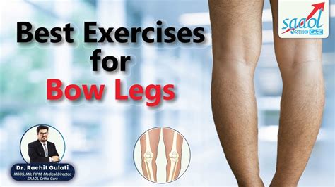 Top Exercises for Bow Legs | Treatment for varus deformity | D Rachit ...