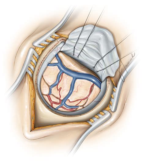 Parietal Craniotomy | The Neurosurgical Atlas