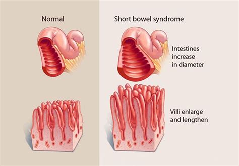 Management of short bowel syndrome in adult patients - Mayo Clinic