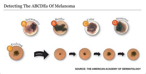 Mole patrol: How to detect and prevent the deadliest form of skin cancer | Lake Region Healthcare