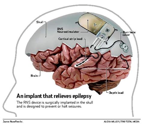 39 best images about EPILEPSY BRAIN SURGERY on Pinterest