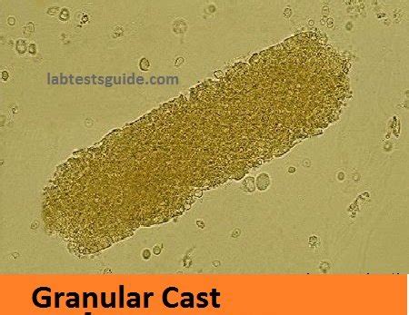 Urinary Casts | Lab Tests Guide